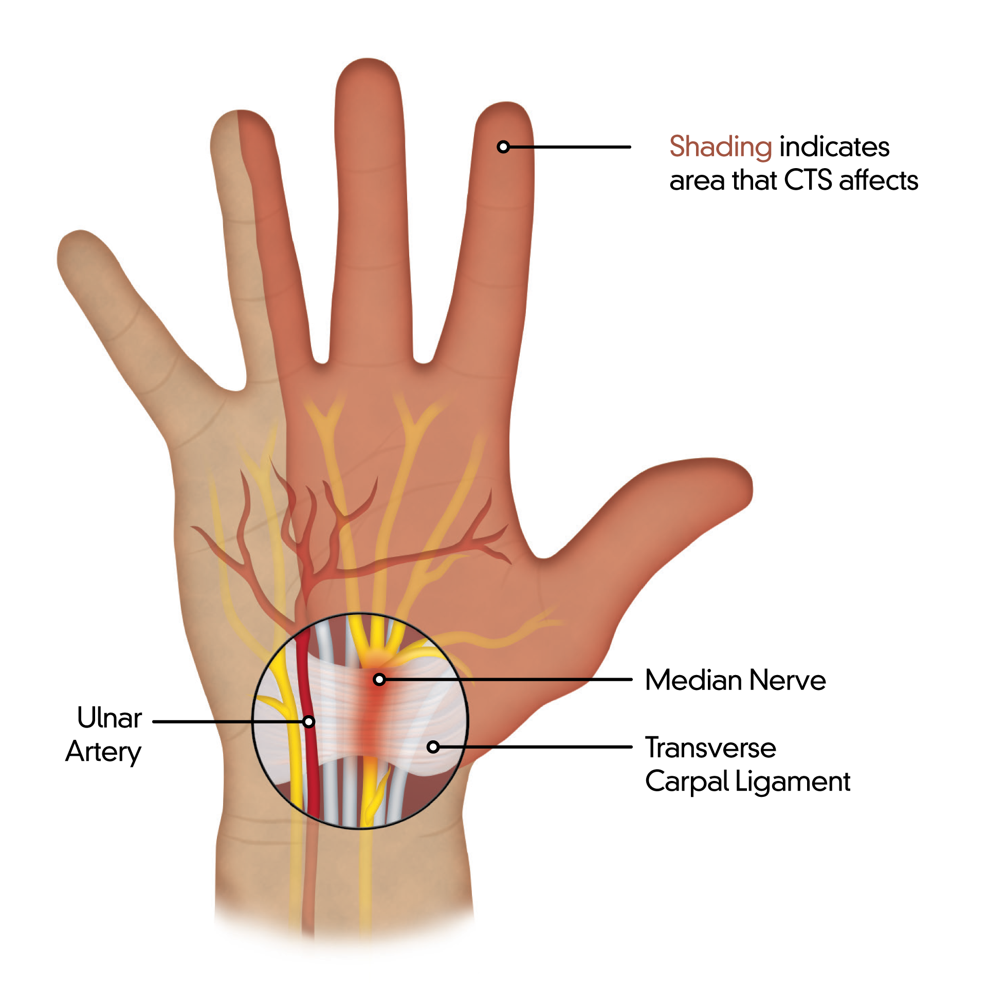 Left hand showing critical anatomy affected by carpal tunnel syndrome highlighting ulnar artery, median nerve, transverse carpal ligament.