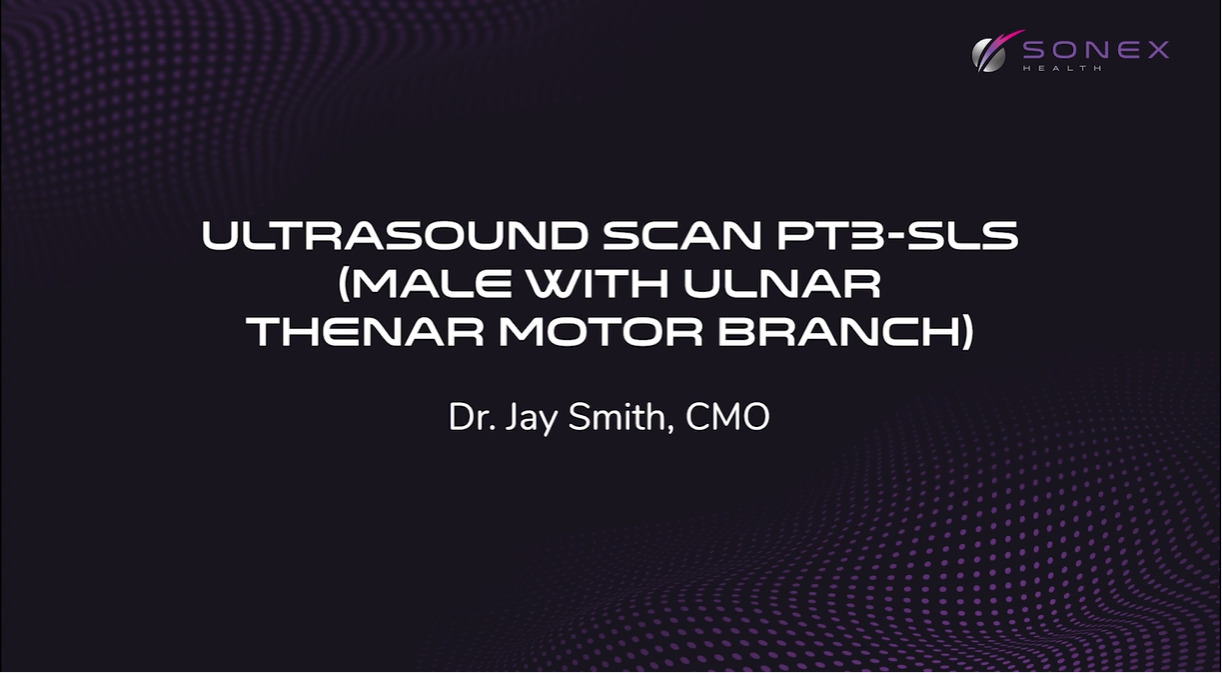 Ultrasound Scan of Carpal Tunnel - Patient with Ulnar Thenar Motor Branch