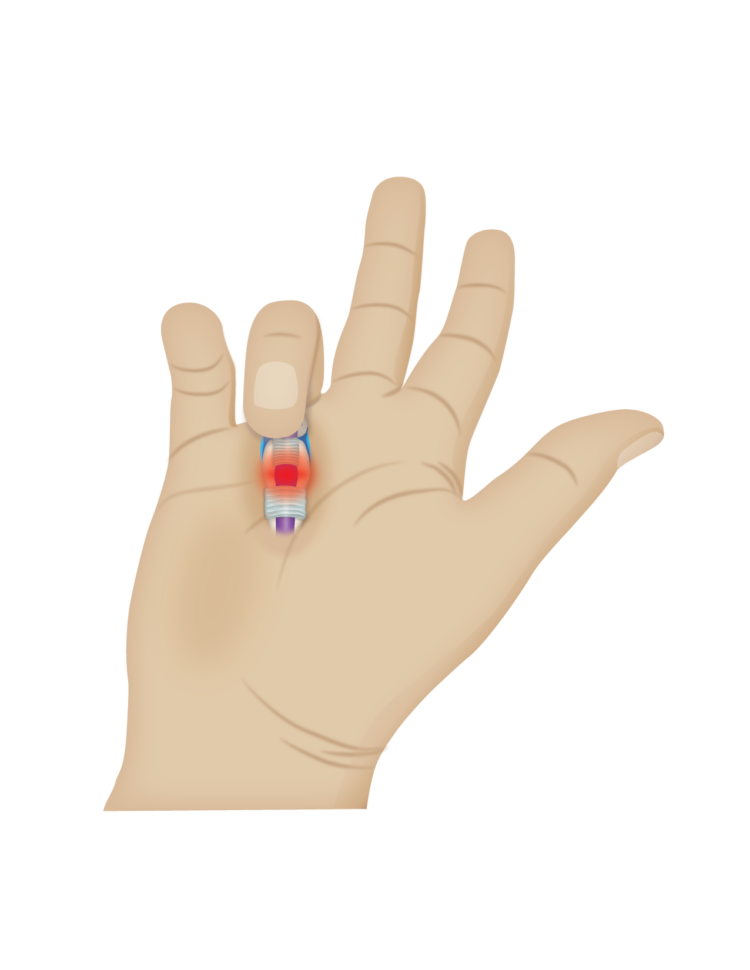 Tenosynovitis: Practice Essentials, Pathophysiology, Etiology