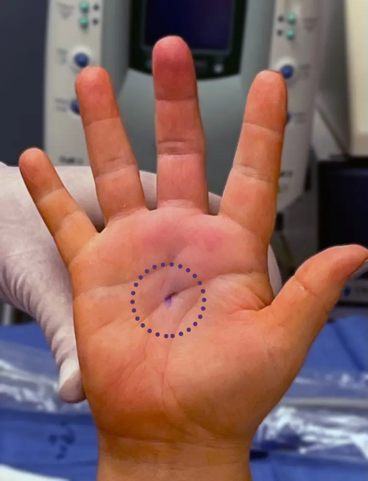 Trigger Finger - Sonex Health