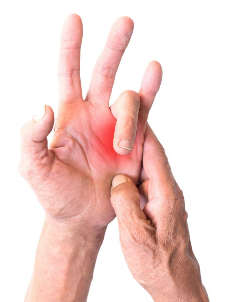 Radiating pain shown on hand caused by trigger finger