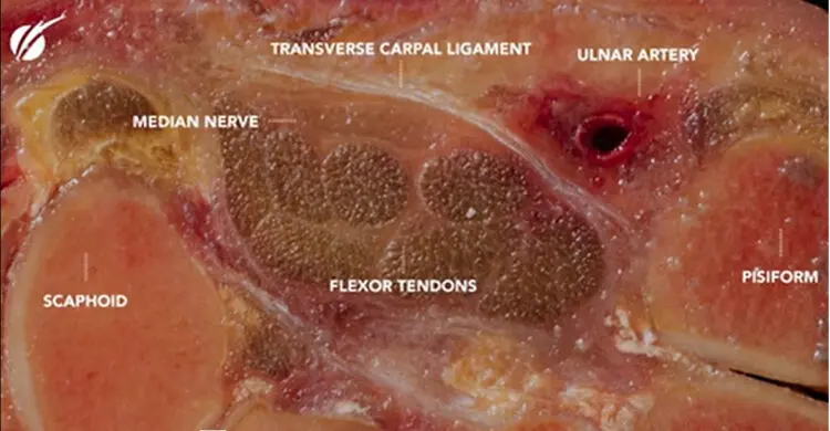 Wrist cross section showing carpal tunnel anatomy