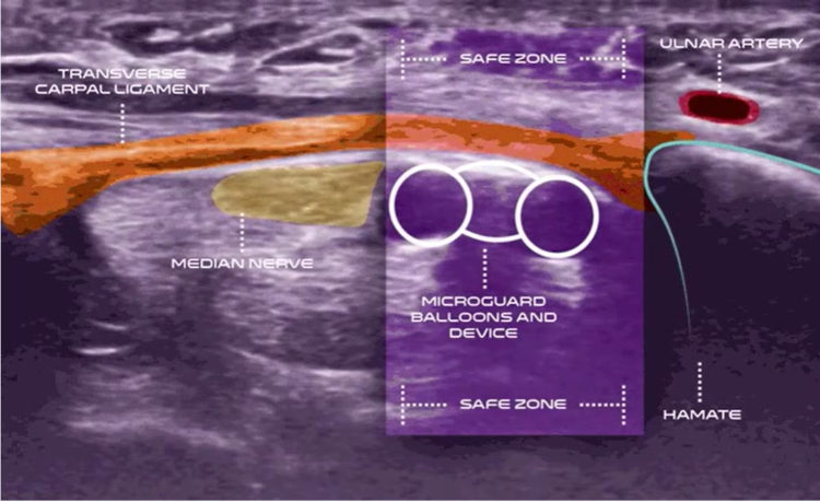 UltraGuideCTR under real-time ultrasound showing carpal tunnel anatomy