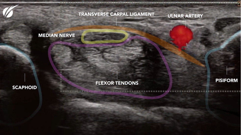 Cross section of the carpal tunnel with ultrasound overlay