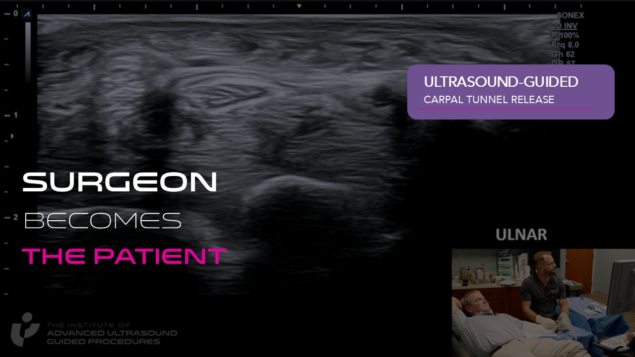 Watch orthopedic surgeon, Dr. Jeff Barwick become the patient as Dr. Johnny Nelson, hand and upper extremity surgeon, performs an ultrasound-guided carpal tunnel release (UGCTR) in a clinic-based procedure room.